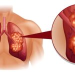 cancer-pulmon-sintomas-ignis-natura