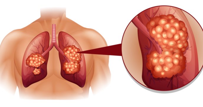 cancer-pulmon-sintomas-ignis-natura